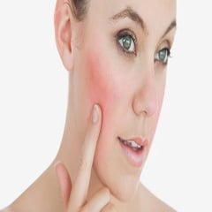 Зачервявания - розацея