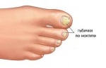 Онихомикоза - гъбички по ноктите